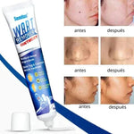 Charger l'image dans la galerie, Crème médicale naturelle pour les verrues cutanées