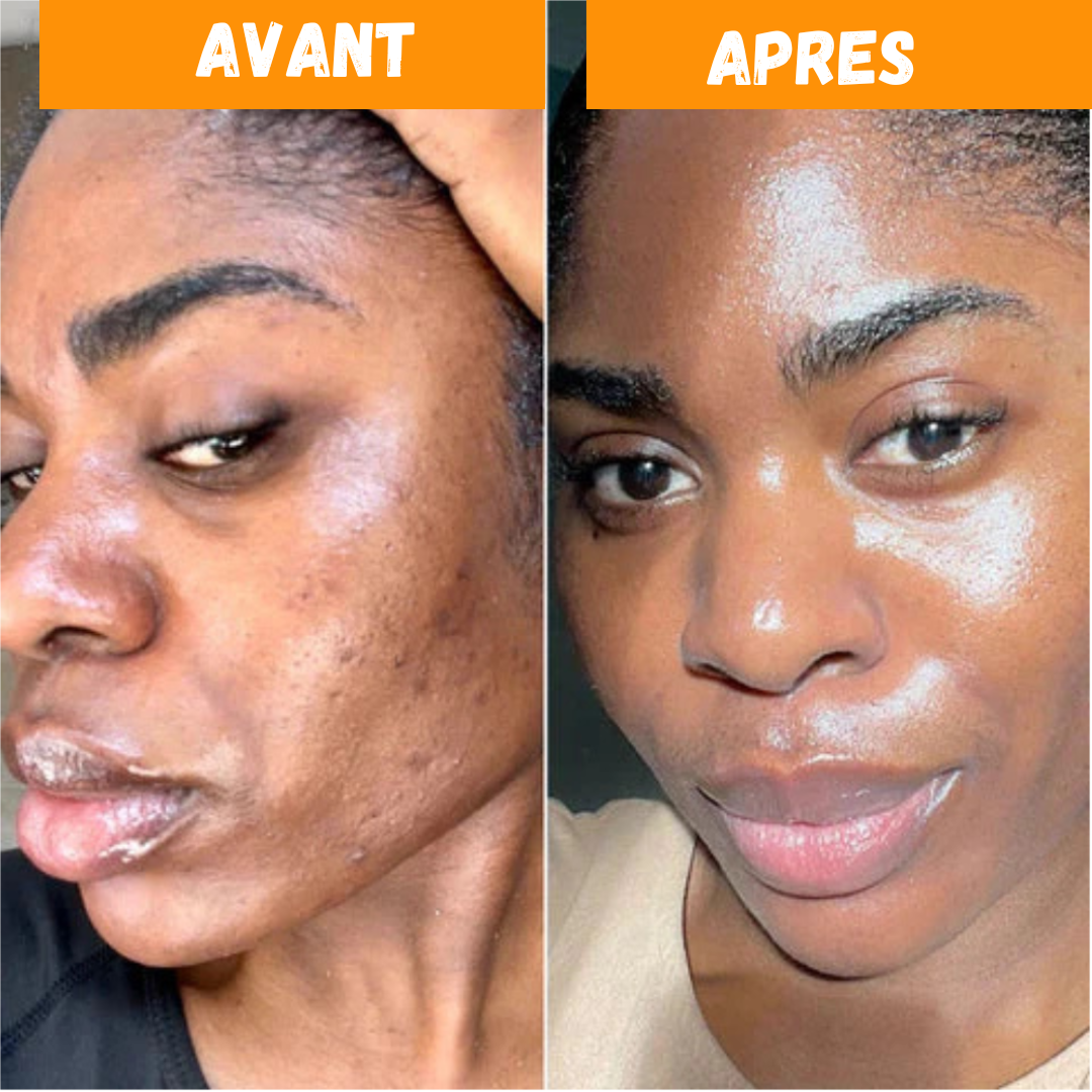 Savon Nettoyant au Kojic - Stock Limité